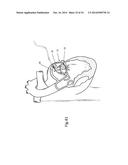 Heart Valve Repair Device diagram and image