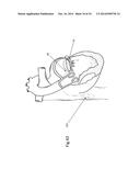 Heart Valve Repair Device diagram and image