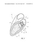 VASCULAR IMPLANT diagram and image