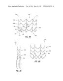 VASCULAR IMPLANT diagram and image