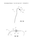 VASCULAR IMPLANT diagram and image