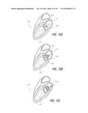 VASCULAR IMPLANT diagram and image