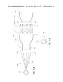 VASCULAR IMPLANT diagram and image