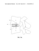 MODULAR, CUSTOMIZABLE SPINE STABILIZATION SYSTEM diagram and image