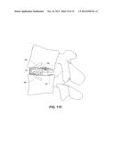 MODULAR, CUSTOMIZABLE SPINE STABILIZATION SYSTEM diagram and image