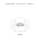 MODULAR, CUSTOMIZABLE SPINE STABILIZATION SYSTEM diagram and image