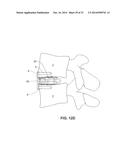 MODULAR, CUSTOMIZABLE SPINE STABILIZATION SYSTEM diagram and image