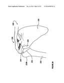 Modular, adjustable, prosthetic, hip/shoulder spacer diagram and image