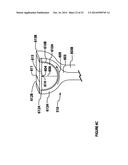 Modular, adjustable, prosthetic, hip/shoulder spacer diagram and image