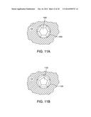 Fusion Implant diagram and image