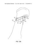 Fusion Implant diagram and image