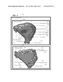 FABRICATION OF AN ORTHODONTIC ALIGNER FROM A NEGATIVE MOLD DESIGNED BY A     COMPUTATIONAL DEVICE diagram and image