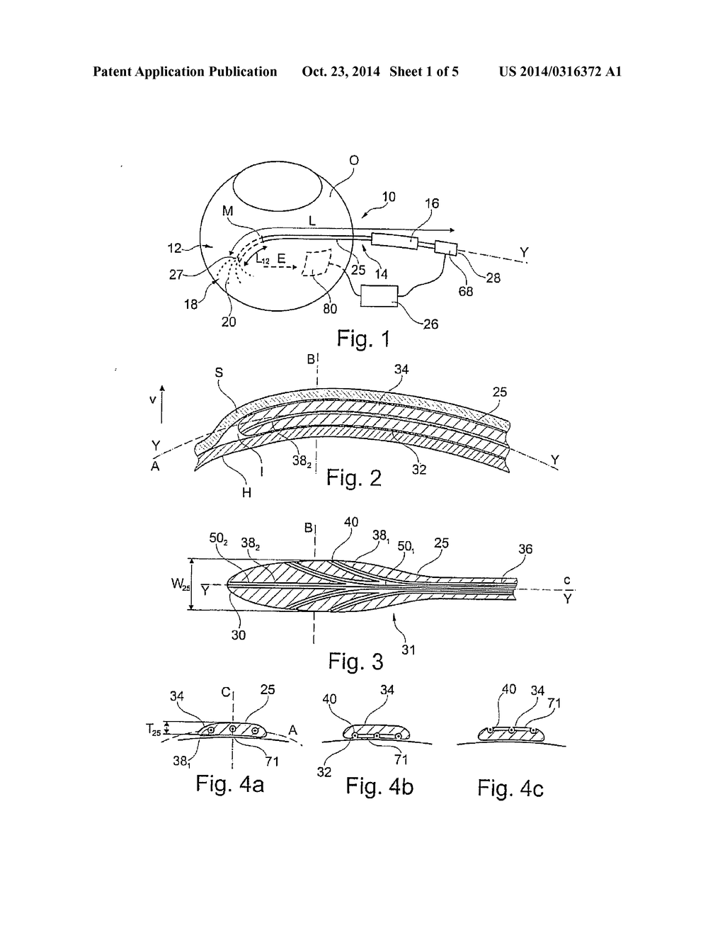 DEVICE FOR THE TREATMENT OF AN OCULAR DISEASE - diagram, schematic, and image 02