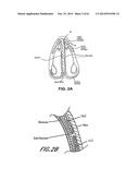 METHODS AND DEVICES TO TREAT NASAL AIRWAYS diagram and image