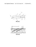 METHODS AND DEVICES TO TREAT NASAL AIRWAYS diagram and image