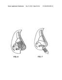 METHODS AND DEVICES TO TREAT NASAL AIRWAYS diagram and image