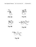 METHODS AND DEVICES TO TREAT NASAL AIRWAYS diagram and image