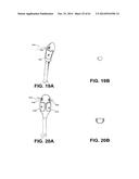 METHODS AND DEVICES TO TREAT NASAL AIRWAYS diagram and image