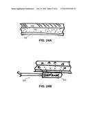 METHODS AND DEVICES TO TREAT NASAL AIRWAYS diagram and image