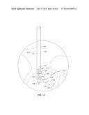 DENERVATION METHODS diagram and image