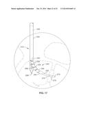 DENERVATION METHODS diagram and image