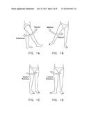 METHOD AND APPARATUS FOR RECONSTRUCTING A HIP JOINT, INCLUDING THE     PROVISION AND USE OF A NOVEL ARTHROSCOPIC DEBRIDEMENT TEMPLATE FOR     ASSISTING IN THE TREATMENT OF CAM-TYPE FEMOROACETABULAR IMPINGEMENT diagram and image