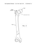 METHOD AND APPARATUS FOR RECONSTRUCTING A HIP JOINT, INCLUDING THE     PROVISION AND USE OF A NOVEL ARTHROSCOPIC DEBRIDEMENT TEMPLATE FOR     ASSISTING IN THE TREATMENT OF CAM-TYPE FEMOROACETABULAR IMPINGEMENT diagram and image