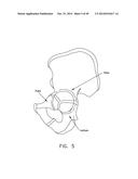 METHOD AND APPARATUS FOR RECONSTRUCTING A HIP JOINT, INCLUDING THE     PROVISION AND USE OF A NOVEL ARTHROSCOPIC DEBRIDEMENT TEMPLATE FOR     ASSISTING IN THE TREATMENT OF CAM-TYPE FEMOROACETABULAR IMPINGEMENT diagram and image