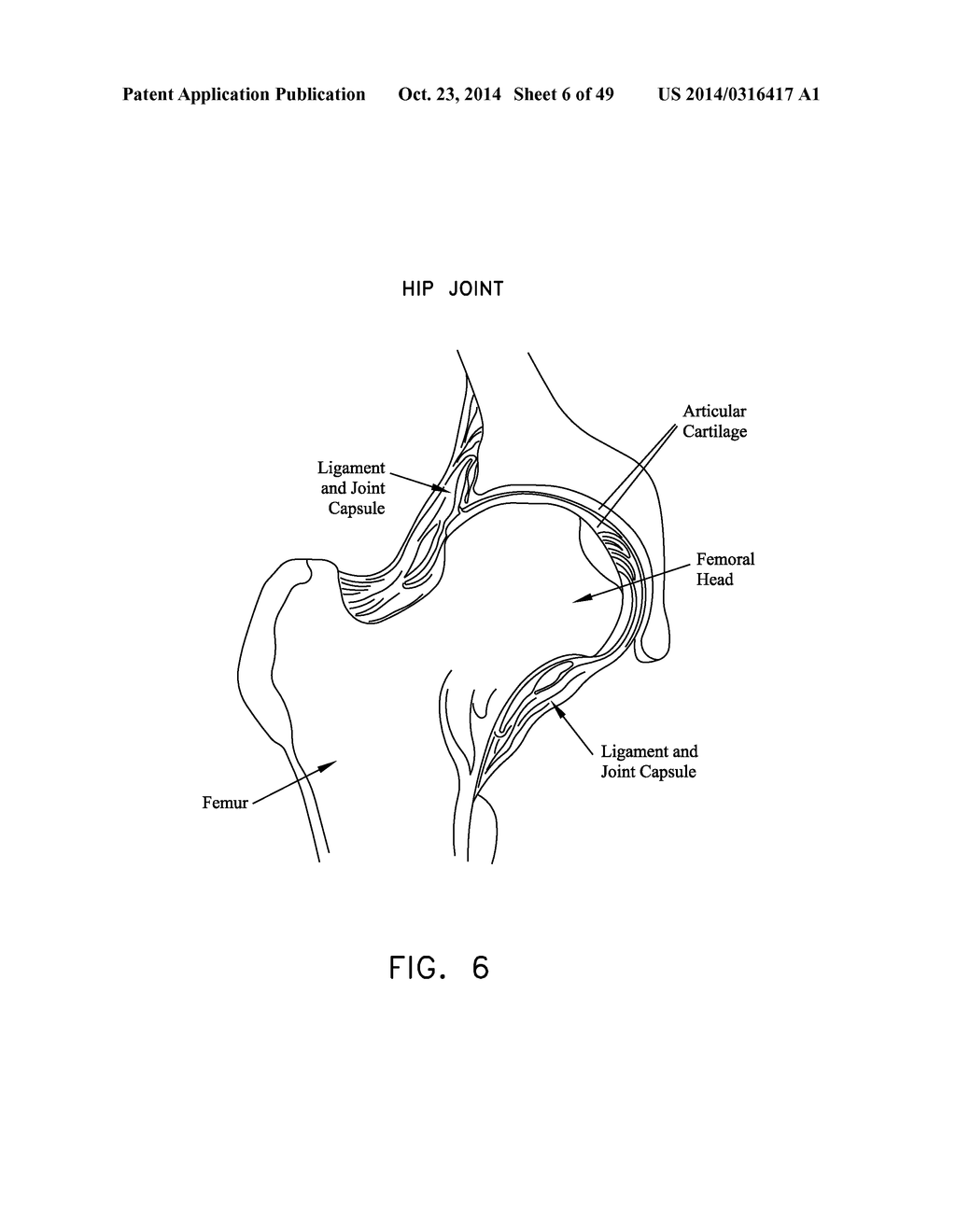 METHOD AND APPARATUS FOR RECONSTRUCTING A HIP JOINT, INCLUDING THE     PROVISION AND USE OF A NOVEL ARTHROSCOPIC DEBRIDEMENT TEMPLATE FOR     ASSISTING IN THE TREATMENT OF CAM-TYPE FEMOROACETABULAR IMPINGEMENT - diagram, schematic, and image 07