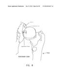 METHOD AND APPARATUS FOR RECONSTRUCTING A HIP JOINT, INCLUDING THE     PROVISION AND USE OF A NOVEL ARTHROSCOPIC DEBRIDEMENT TEMPLATE FOR     ASSISTING IN THE TREATMENT OF CAM-TYPE FEMOROACETABULAR IMPINGEMENT diagram and image