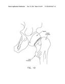 METHOD AND APPARATUS FOR RECONSTRUCTING A HIP JOINT, INCLUDING THE     PROVISION AND USE OF A NOVEL ARTHROSCOPIC DEBRIDEMENT TEMPLATE FOR     ASSISTING IN THE TREATMENT OF CAM-TYPE FEMOROACETABULAR IMPINGEMENT diagram and image