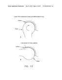 METHOD AND APPARATUS FOR RECONSTRUCTING A HIP JOINT, INCLUDING THE     PROVISION AND USE OF A NOVEL ARTHROSCOPIC DEBRIDEMENT TEMPLATE FOR     ASSISTING IN THE TREATMENT OF CAM-TYPE FEMOROACETABULAR IMPINGEMENT diagram and image