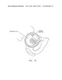 METHOD AND APPARATUS FOR RECONSTRUCTING A HIP JOINT, INCLUDING THE     PROVISION AND USE OF A NOVEL ARTHROSCOPIC DEBRIDEMENT TEMPLATE FOR     ASSISTING IN THE TREATMENT OF CAM-TYPE FEMOROACETABULAR IMPINGEMENT diagram and image