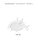 METHOD AND APPARATUS FOR RECONSTRUCTING A HIP JOINT, INCLUDING THE     PROVISION AND USE OF A NOVEL ARTHROSCOPIC DEBRIDEMENT TEMPLATE FOR     ASSISTING IN THE TREATMENT OF CAM-TYPE FEMOROACETABULAR IMPINGEMENT diagram and image