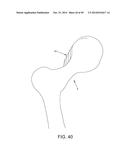 METHOD AND APPARATUS FOR RECONSTRUCTING A HIP JOINT, INCLUDING THE     PROVISION AND USE OF A NOVEL ARTHROSCOPIC DEBRIDEMENT TEMPLATE FOR     ASSISTING IN THE TREATMENT OF CAM-TYPE FEMOROACETABULAR IMPINGEMENT diagram and image