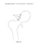 METHOD AND APPARATUS FOR RECONSTRUCTING A HIP JOINT, INCLUDING THE     PROVISION AND USE OF A NOVEL ARTHROSCOPIC DEBRIDEMENT TEMPLATE FOR     ASSISTING IN THE TREATMENT OF CAM-TYPE FEMOROACETABULAR IMPINGEMENT diagram and image