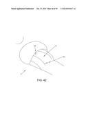 METHOD AND APPARATUS FOR RECONSTRUCTING A HIP JOINT, INCLUDING THE     PROVISION AND USE OF A NOVEL ARTHROSCOPIC DEBRIDEMENT TEMPLATE FOR     ASSISTING IN THE TREATMENT OF CAM-TYPE FEMOROACETABULAR IMPINGEMENT diagram and image