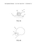 METHOD AND APPARATUS FOR RECONSTRUCTING A HIP JOINT, INCLUDING THE     PROVISION AND USE OF A NOVEL ARTHROSCOPIC DEBRIDEMENT TEMPLATE FOR     ASSISTING IN THE TREATMENT OF CAM-TYPE FEMOROACETABULAR IMPINGEMENT diagram and image