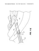 APPARATUS FOR THE TREATMENT OF TISSUE diagram and image