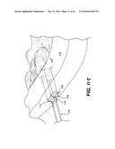 APPARATUS FOR THE TREATMENT OF TISSUE diagram and image