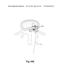 APPARATUS FOR THE TREATMENT OF TISSUE diagram and image