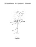 APPARATUS FOR THE TREATMENT OF TISSUE diagram and image