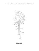 APPARATUS FOR THE TREATMENT OF TISSUE diagram and image