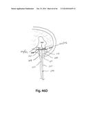 APPARATUS FOR THE TREATMENT OF TISSUE diagram and image