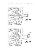 Bone Repair System and Method diagram and image