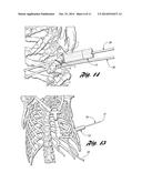 Bone Repair System and Method diagram and image