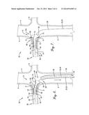 INTERCONNECTION BETWEEN SELECTIVELY-EXPANDABLE AND SELF-EXPANDABLE     SECTIONS OF AN OSTIAL STENT diagram and image