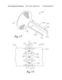 INTERCONNECTION BETWEEN SELECTIVELY-EXPANDABLE AND SELF-EXPANDABLE     SECTIONS OF AN OSTIAL STENT diagram and image