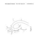 HEART VALVE AND ENDOVASCULAR GRAFT COMPONENTS AND METHOD FOR DELIVERY diagram and image