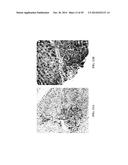 Methods and Agents for the Diagnosis and Treatment of Hepatocellular     Carcinoma diagram and image
